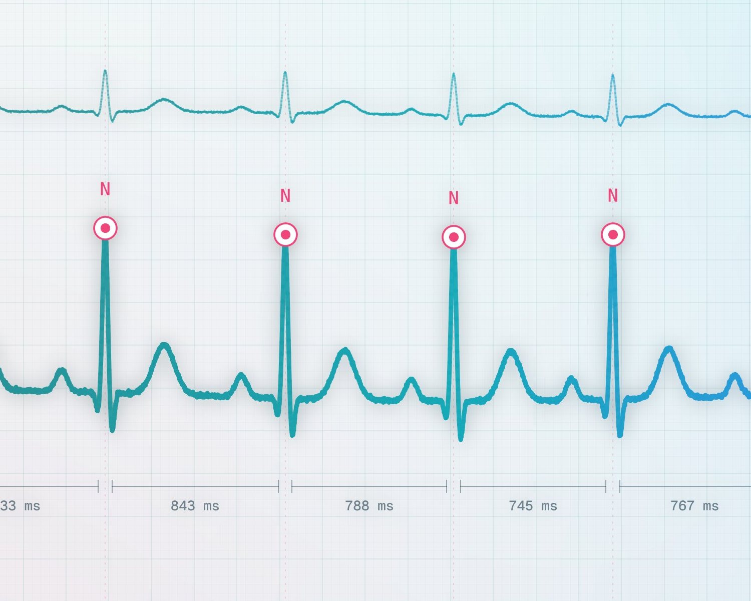 Synthetisches EKG mit erkannten R-Zacken und RR-Intervallen